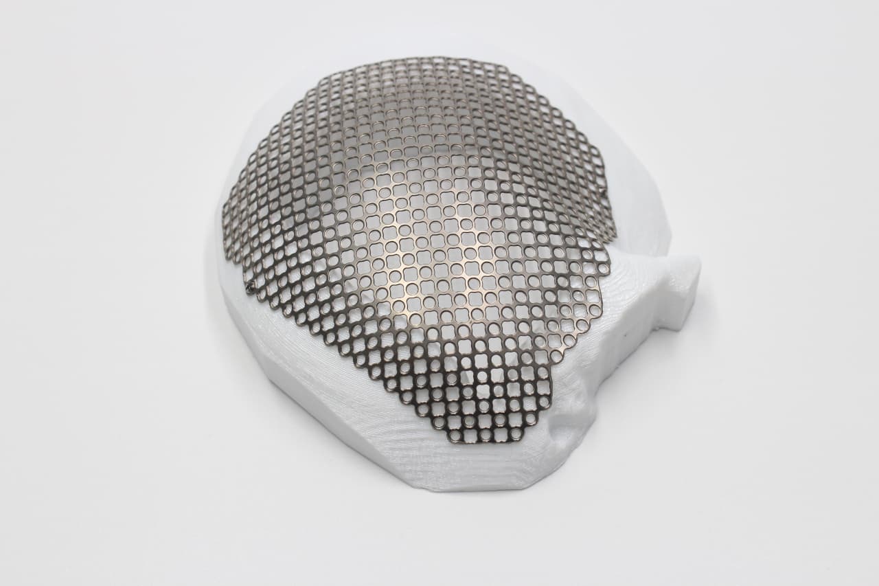 Titanium Mesh Implant
