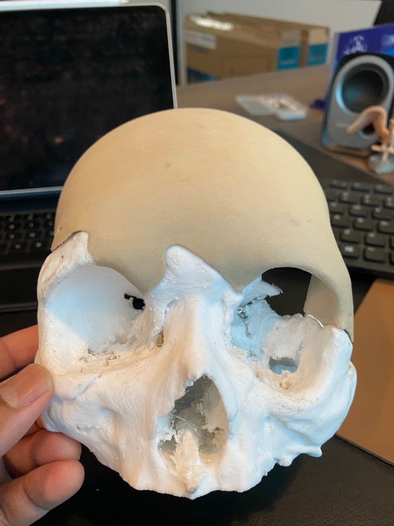 Our LOGIC PSI PEEK implant..now available & affordable 🤩
