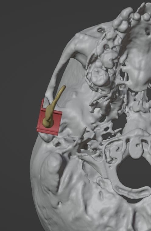3D imaging of temporomandibular joint for patient-specific surgical planning